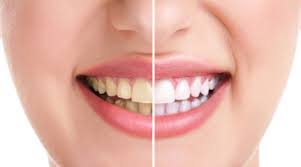 Nguyên nhân gây xỉn màu răng và những lưu ý khi tẩy trắng răng