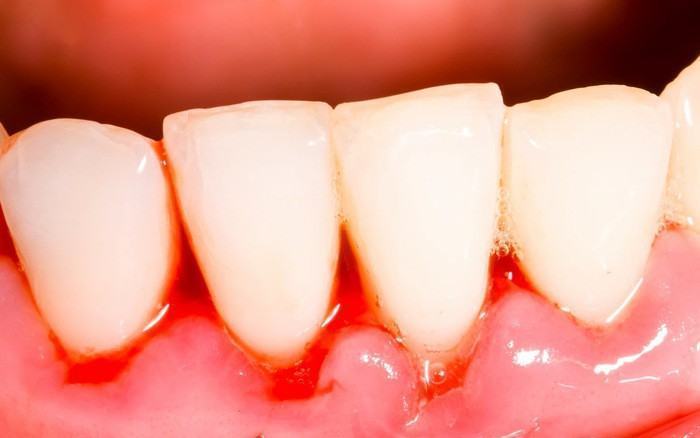 bệnh nướu răng không hợp đến dán sứ veneer