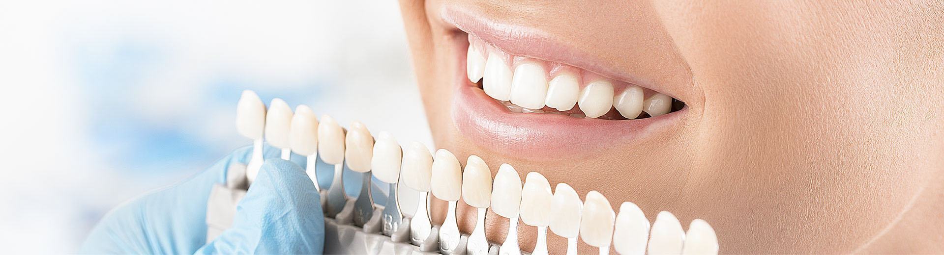 Dán răng sứ veneer loại nào tốt nhất?