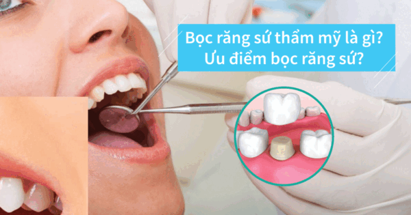 Bọc răng sứ thẩm mỹ là gì? Ưu điểm bọc răng sứ? Bọc răng sứ có đau không? Giá bao nhiêu?