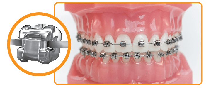 thời gian niềng rút ngắn từ 3 – 6 tháng tùy vào tình trạng của răng khi sử dụng loại mắc cài này