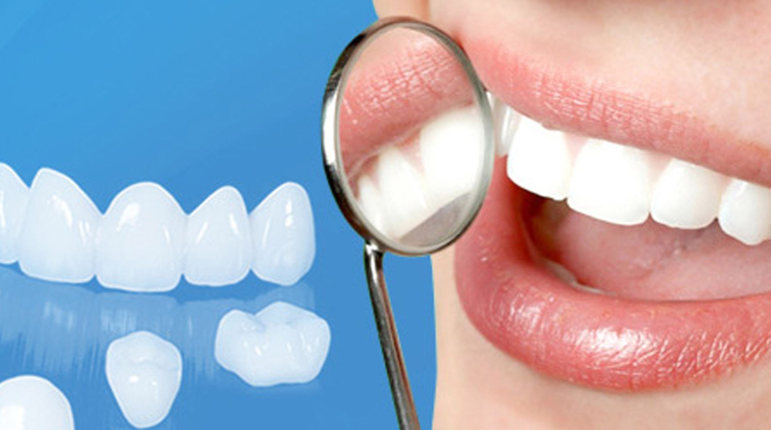 Nên chọn loại răng sứ nào cho răng?