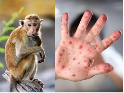Bệnh đậu mùa khỉ có nguy hiểm tính mạng không?